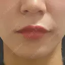 ボトックス（あご） / ボトックス（口角） / ボトックス（肩） / ボトックス（人中） EMMO FACE CLINIC 大宮院 DAY 1 サムネイル用