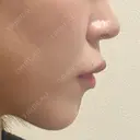 ボトックス（あご） / ボトックス（口角） / ボトックス（肩） / ボトックス（人中） EMMO FACE CLINIC 大宮院 DAY 1 サムネイル用