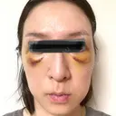 クマ治療 X CLINIC 銀座院 DAY 4 サムネイル用