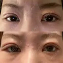 二重埋没 / 眼瞼下垂（非切開） BRIGHTS beauty clinic DAY 1 サムネイル用