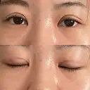 二重埋没 / 眼瞼下垂（非切開） BRIGHTS beauty clinic DAY 12 サムネイル用
