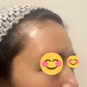 脂肪注入（額） S.T styleクリニック DAY 27 サムネイル用