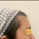 脂肪注入（額） S.T styleクリニック DAY 27 サムネイル用