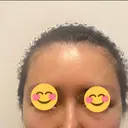 脂肪注入（額） S.T styleクリニック DAY 27 サムネイル用