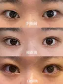 二重埋没 表参道スキンクリニック 表参道院 DAY 7 サムネイル用