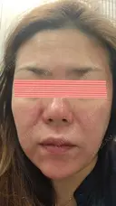 ダーマペン RAISE CLINIC 【レイズクリニック】 DAY 0 サムネイル用