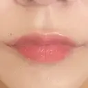 ボトックス（あご） / ボトックス（口角） / ボトックス（肩） / ボトックス（人中） EMMO FACE CLINIC 大宮院 DAY 5 サムネイル用