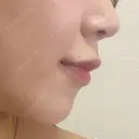 ボトックス（あご） / ボトックス（口角） / ボトックス（肩） / ボトックス（人中） EMMO FACE CLINIC 大宮院 DAY 5 サムネイル用