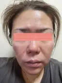 ダーマペン RAISE CLINIC 【レイズクリニック】 DAY 2 サムネイル用