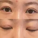 二重埋没 / 眼瞼下垂（非切開） BRIGHTS beauty clinic AFTER サムネイル用
