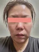 ダーマペン RAISE CLINIC 【レイズクリニック】 DAY 3 サムネイル用