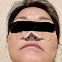 隆鼻術 / 鼻中隔延長（切開） / 軟骨移植 エースクリニック 名古屋院 AFTER サムネイル用