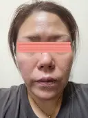 ダーマペン RAISE CLINIC 【レイズクリニック】 DAY 4 サムネイル用