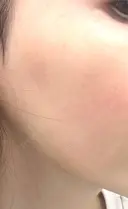 その他（肌） / エレクトロポレーション 湘南美容クリニック 静岡院 DAY 58 サムネイル用