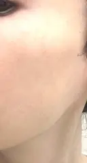 その他（肌） / エレクトロポレーション 湘南美容クリニック 静岡院 DAY 58 サムネイル用