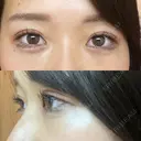 クマ治療 X CLINIC 銀座院 AFTER サムネイル用