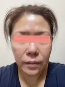 ダーマペン RAISE CLINIC 【レイズクリニック】 DAY 5 サムネイル用