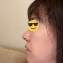 鼻尖形成（切開） / 鼻中隔延長（切開） / 小鼻縮小（切開） / 鼻尖縮小 グローバルビューティークリニック 東京院 DAY 14 サムネイル用