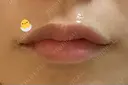 ボトックス（あご） / ボトックス（口角） / ボトックス（肩） / ボトックス（人中） EMMO FACE CLINIC 大宮院 AFTER サムネイル用