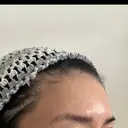 脂肪注入（額） S.T styleクリニック DAY 29 サムネイル用