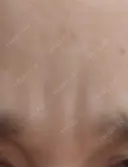 ボトックス（眉間） TCB東京中央美容外科 新横浜院 DAY 26 サムネイル用