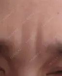 ボトックス（眉間） TCB東京中央美容外科 新横浜院 DAY 27 サムネイル用