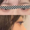 ヒアルロン酸注入（涙袋） NARU Beauty Clinic 【ナルクリ】 DAY 0 サムネイル用
