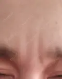 ボトックス（眉間） TCB東京中央美容外科 新横浜院 DAY 28 サムネイル用