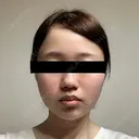 糸リフト / バッカルファット除去 SEA CLINIC（シークリニック） DAY 10 サムネイル用