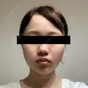 糸リフト / バッカルファット除去 SEA CLINIC（シークリニック） DAY 12 サムネイル用