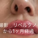 その他（鼻） / 鼻尖縮小 / 肌ヒアルロン酸注入（たるみ・シワ改善） / ヒアルロン酸注入（唇） / シワ取りボトックス / ヒアルロン酸注入（ほうれい線） 東京形成美容外科 船橋院 AFTER サムネイル用