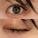 二重埋没 ルネッサンス美容外科医院 神戸院 DAY 31 サムネイル用