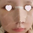 隆鼻術 / 鼻尖形成（切開） / 小鼻縮小（切開） / 軟骨移植 ASTRA BEAUTY CLINIC DAY 3 サムネイル用