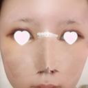 隆鼻術 / 鼻尖形成（切開） / 小鼻縮小（切開） / 軟骨移植 ASTRA BEAUTY CLINIC DAY 4 サムネイル用