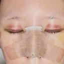 隆鼻術 / 鼻尖形成（切開） / 小鼻縮小（切開） / 軟骨移植 ASTRA BEAUTY CLINIC DAY 5 サムネイル用