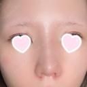 隆鼻術 / 鼻尖形成（切開） / 小鼻縮小（切開） / 軟骨移植 ASTRA BEAUTY CLINIC DAY 10 サムネイル用