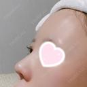 隆鼻術 / 鼻尖形成（切開） / 小鼻縮小（切開） / 軟骨移植 ASTRA BEAUTY CLINIC DAY 10 サムネイル用