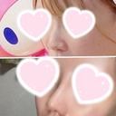 隆鼻術 / 鼻尖形成（切開） / 小鼻縮小（切開） / 軟骨移植 ASTRA BEAUTY CLINIC DAY 13 サムネイル用