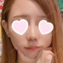 隆鼻術 / 鼻尖形成（切開） / 小鼻縮小（切開） / 軟骨移植 ASTRA BEAUTY CLINIC AFTER サムネイル用