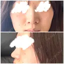 鼻尖形成（切開） / 小鼻縮小（切開） / 軟骨移植 / 鼻尖縮小 高崎美容クリニック DAY 154 サムネイル用