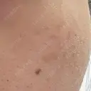 ピコスポット LOUIS CLINIC 二子玉川院【ルイクリニック】 DAY 92 サムネイル用