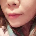 ヒアルロン酸注入（あご） TCB東京中央美容外科 世田谷院 DAY 2 サムネイル用