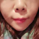 ヒアルロン酸注入（あご） TCB東京中央美容外科 世田谷院 DAY 2 サムネイル用