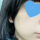 光治療（フォトフェイシャルなど） メディアージュクリニック 名古屋院 DAY 4 サムネイル用