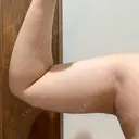 脂肪冷却（二の腕） Anterior 大阪梅田院 DAY 4 サムネイル用