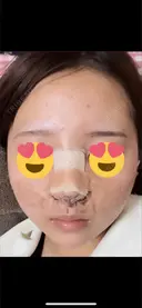 鼻尖形成（切開） / 小鼻縮小（切開） / 軟骨移植 / 鼻柱下降・鼻唇角形成（猫手術） / ヒアルロン酸注入（あご） グローバルビューティークリニック 東京院 DAY 0 サムネイル用