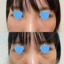 クマ治療 / 下まぶたたるみ取り / 下まぶたの脂肪取り / 脂肪注入（目の下） お茶の水美容形成クリニック AFTER サムネイル用