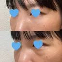 クマ治療 / 下まぶたたるみ取り / 下まぶたの脂肪取り / 脂肪注入（目の下） お茶の水美容形成クリニック DAY 33 サムネイル用