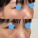 クマ治療 / 下まぶたたるみ取り / 下まぶたの脂肪取り / 脂肪注入（目の下） お茶の水美容形成クリニック DAY 33 サムネイル用