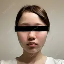 糸リフト / バッカルファット除去 SEA CLINIC（シークリニック） DAY 15 サムネイル用